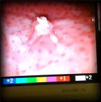 The Mucosal lining pooches upward where the biopsy sample pulled away