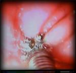 Magnification of metal biopsy instrument pinching a sore bit of stomach mucosal lining in a Boxer dog