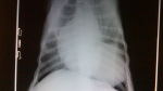 Dog's Chest X-ray looks like two hearts, but really, the round thing on the right of the picture is a tumor that is as big as the heart