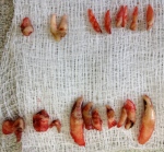 extracted teeth laid out on scratchy gauze pad. unsaveable teeth have crusts of thick hard irregular tartar embedded with bacteria
